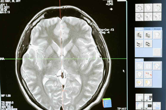 El tamaño cerebral no está relacionado con la inteligencia (Foto: redes sociales)