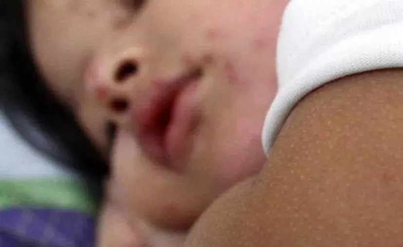 Quintana Roo lidera casos de varicela en la península [Foto: Archivo Sipse]