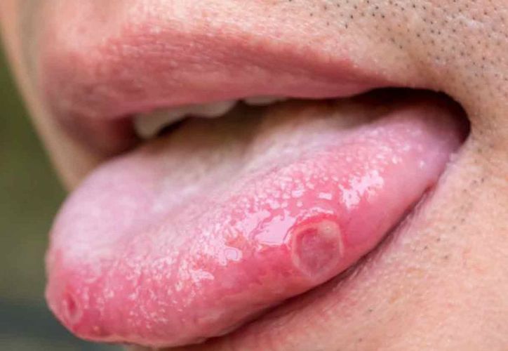 Informacion de Las Enfermedades de Transmision Sexual, Llagas en la boca virus del papiloma humano